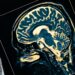 Alzheimer için umut veren çalışma: Nöronlar “çöp”ten geri kazanıldı