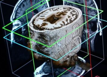 Yapay zeka, demans hastalığını ‘bir günde tespit edebilir’