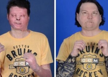 Dünyanın ilk başarılı çift el ve yüz nakli yapıldı: ‘Bana verilen bu ikinci şans için minnettarız’