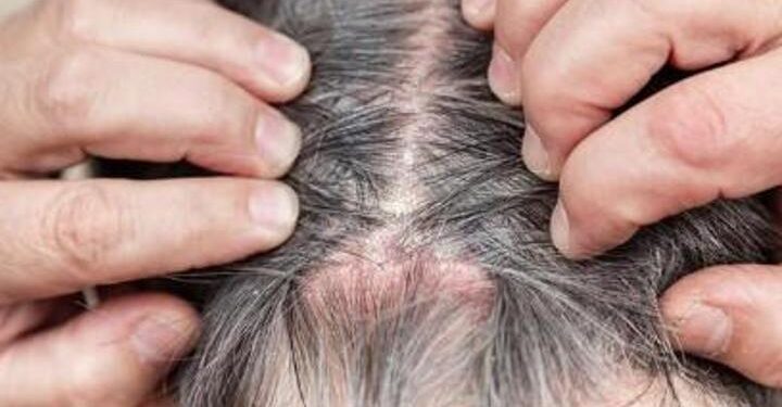 Saçtaki egzamayı geçiren mucize gibi yöntem! Saç cildini besleyen evde maske!