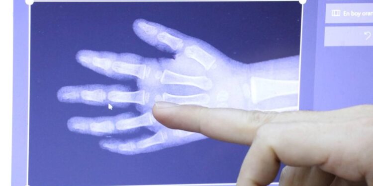 Kemik yaşını yapay zeka ile tespit edecek sistem geliştirildi